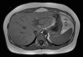 Before and After Liver Healing